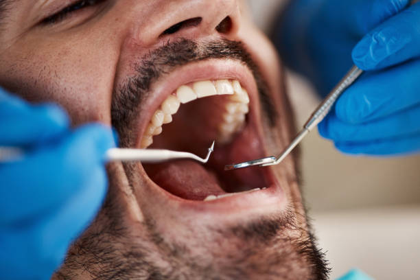 Best Emergency Dental Care for Broken or Chipped Teeth in Anderson, MO